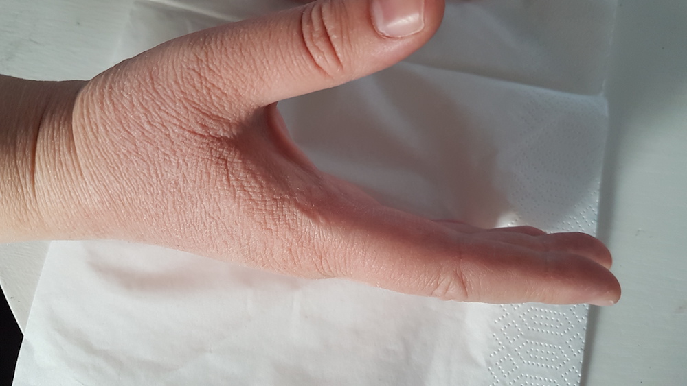 Mai™ SKIN gav hjälp mot Idas torra händer