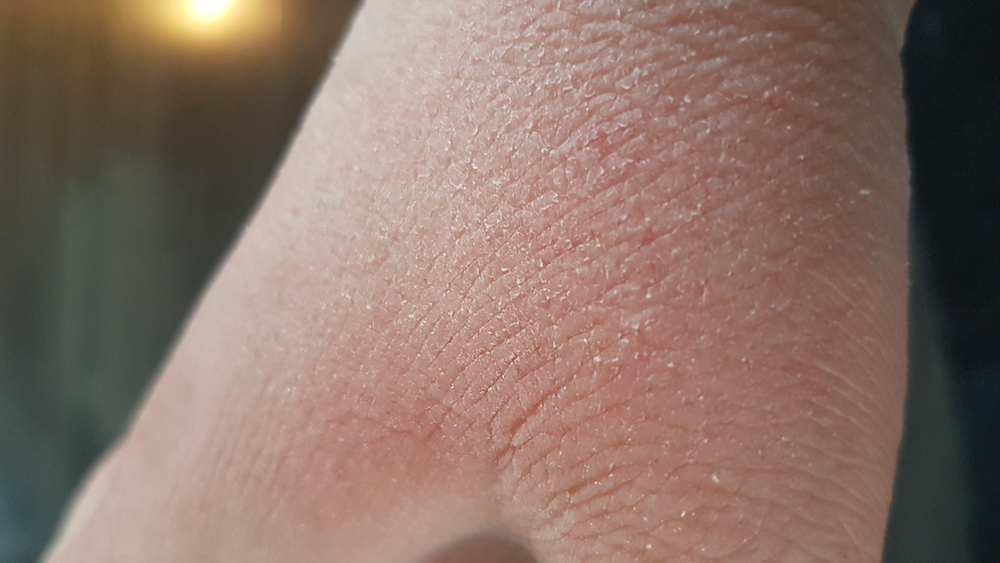 Mai™ SKIN gav hjälp mot Idas torra händer